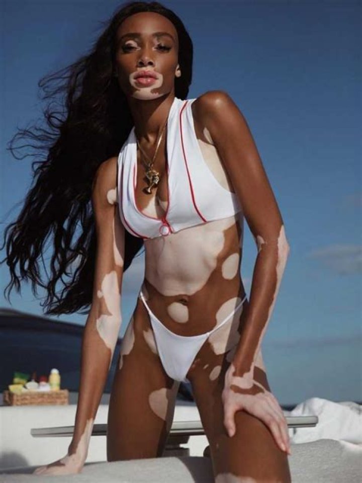 Winnie Harlow Height, Weight, Measurements, Bra Size, Shoe Size